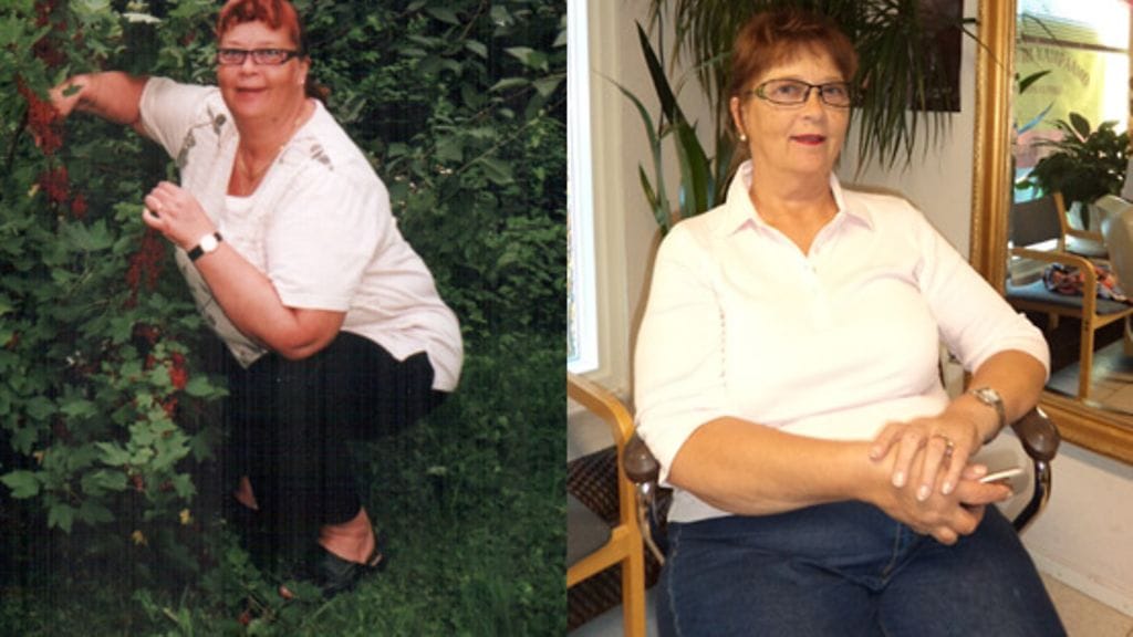 Vasemmalla Ritva ennen leikkausta ja oikealla leikkauksen jälkeen.