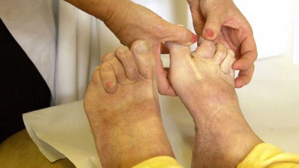 Nivelreuma on merkittävin tulehduksellinen reumasairaus.