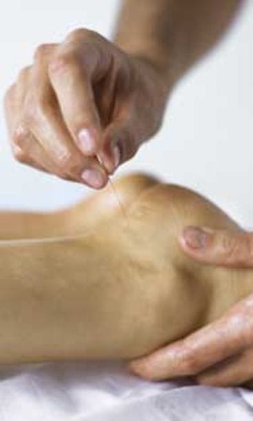 Akupunktio poisti piinaavan kivun.