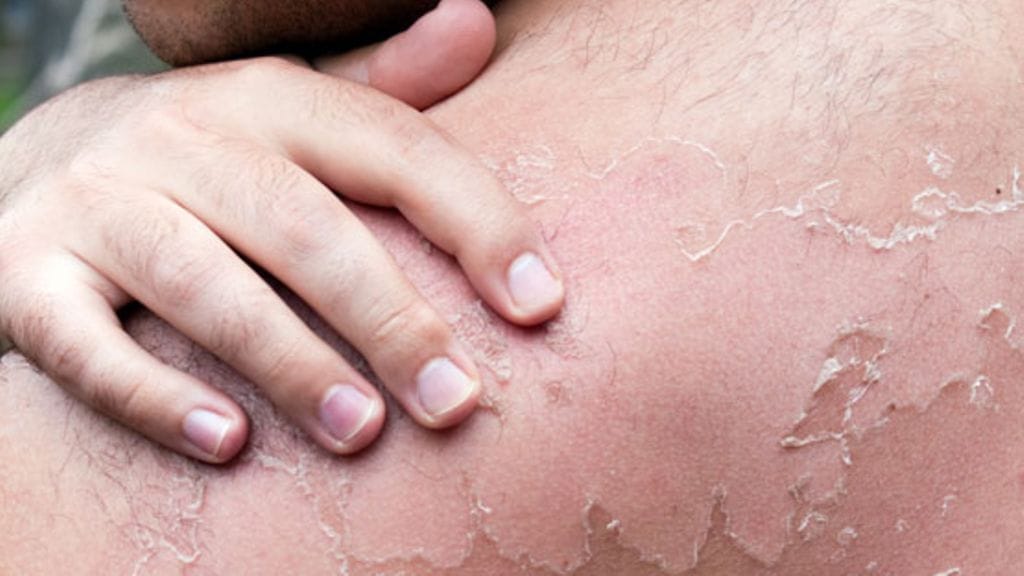 Auringosta tulleet palovammat jäävät ihon muistiin.