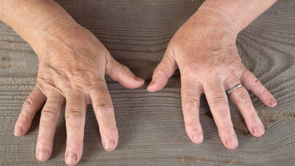 Nivelreuman ensimmäinen oire on käsien jäykkyys.