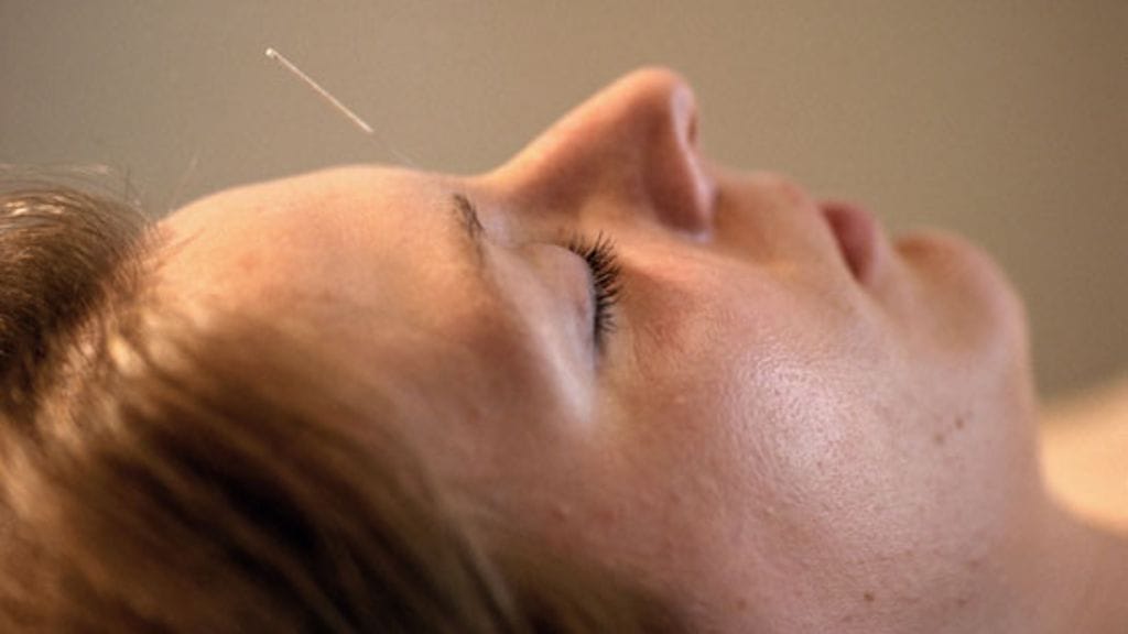 Nina Haavisto suosittelee menemään kosmeettiseen akupunktioon esimerkiksi ennen juhlia. Kuvituskuva.