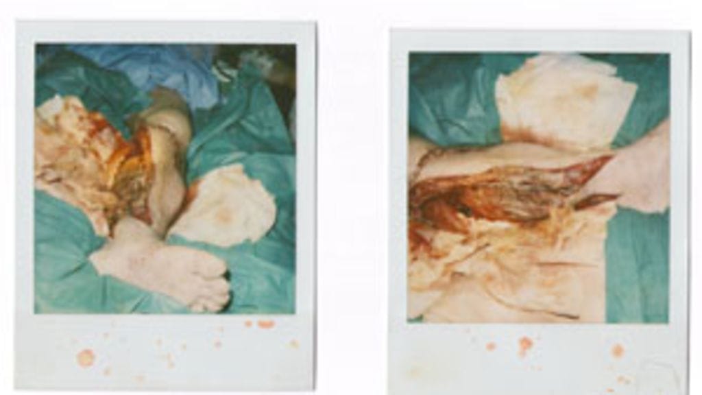 Heinäahon jalka, epäonnistuneen säärihoidon jälkeen.