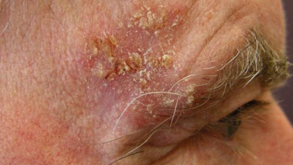 Tässä kuvassa okasolusyöpä.