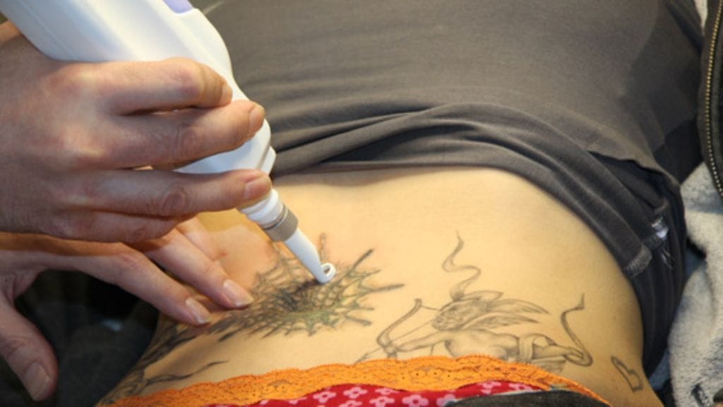 Siiri Mustosen tatuointia vaalennetaan laserilla.