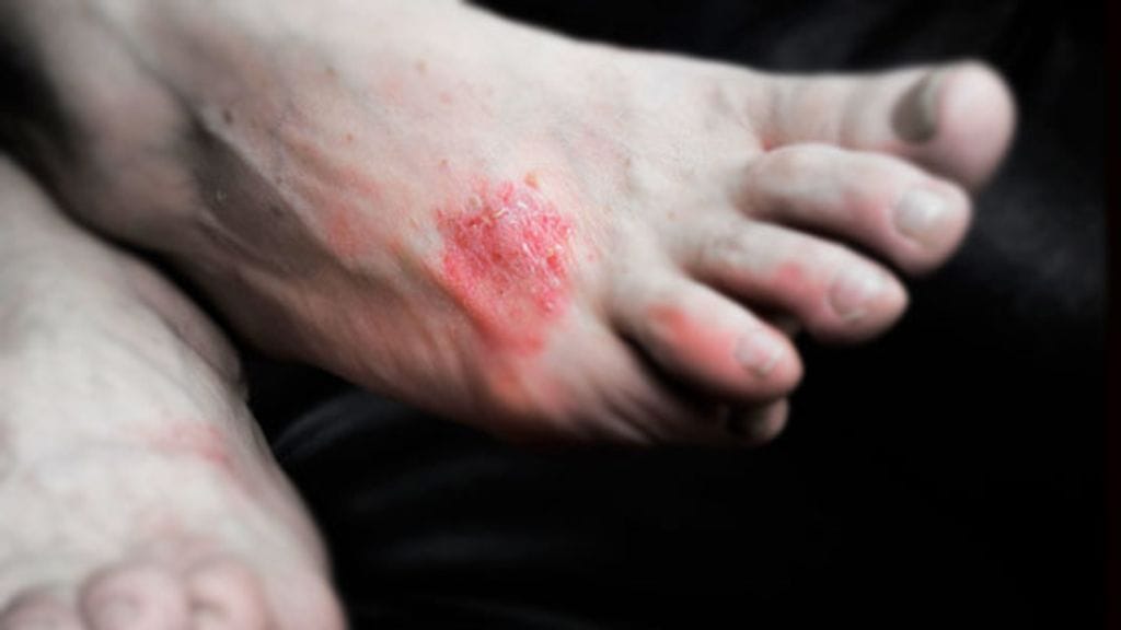 Psoriasis on eräs tulehduksellisista ihosairauksista.