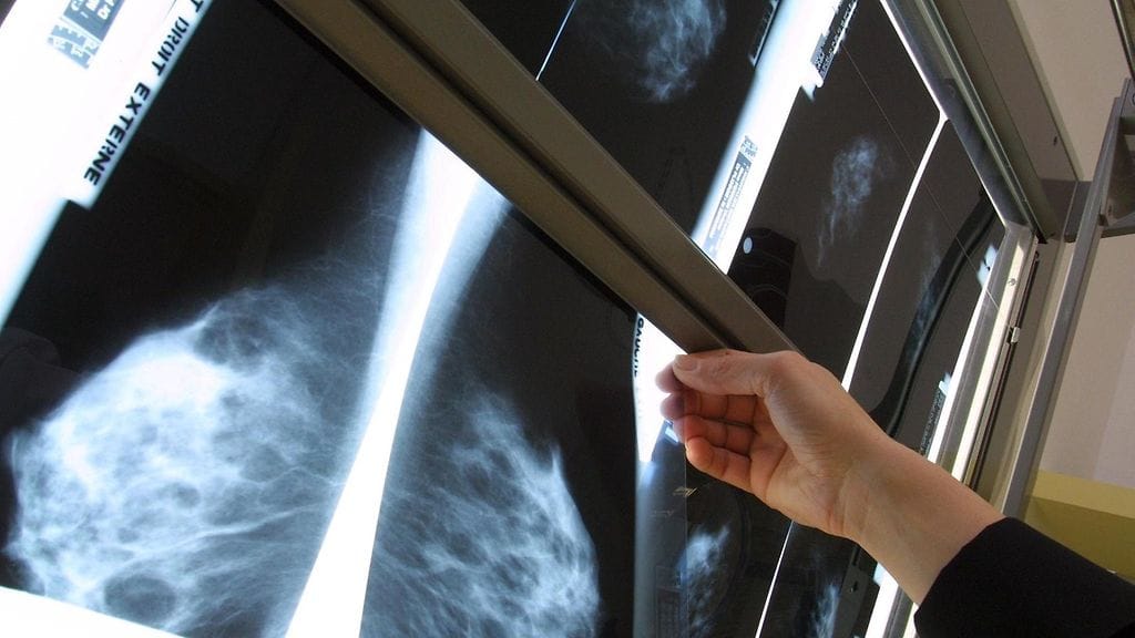 Rintasyöpää seulotaan mammografialla.