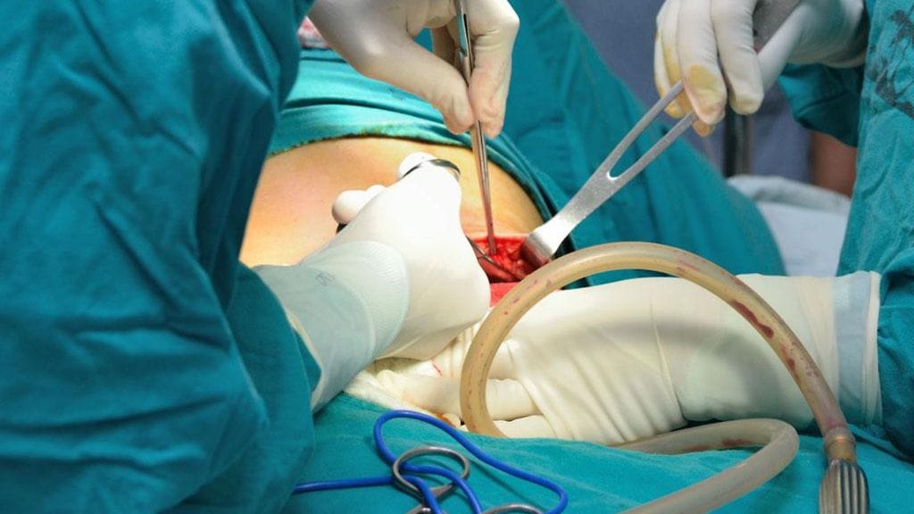 keisarileikkaus.JPG (1)