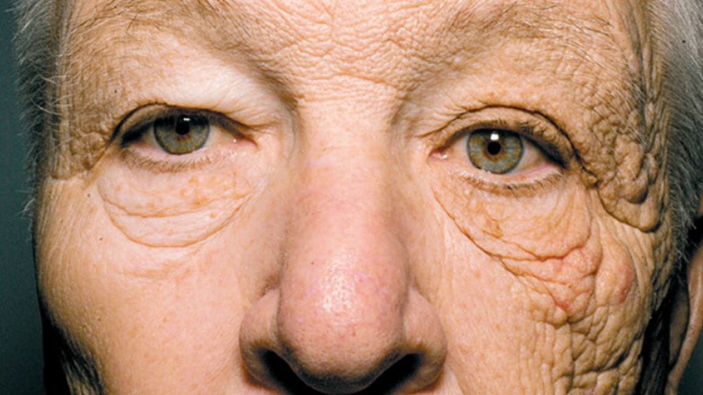 UV-säteily tekee pahaa jälkeä.