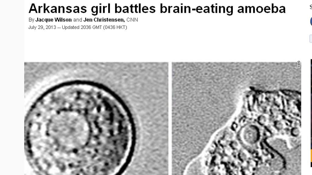 Yhdysvalloissa 12-vuotiaalla tytöllä on todettu harvinainen ja yleensä tappava loistartunta. Kuvakaappaus CNN:n sivuilta.