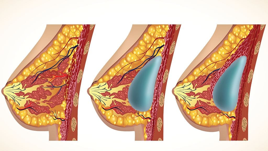 Rinta ennen leikkausta, rintalihaksen päälle (kesk.) ja alle (oik.) asennettu implantti.