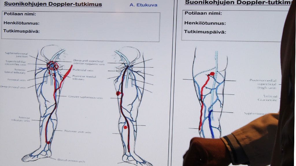 Tom Schröder, kirurgian professori Laser Tilkasta esittelee esittelee suonikohjujen syntyä