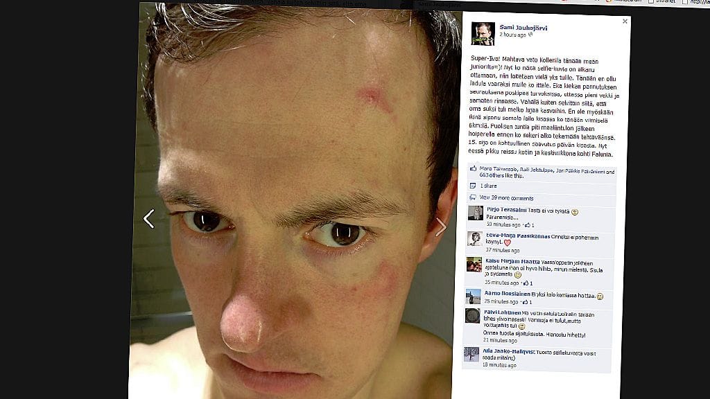 Sami Jauhojärvi esitteli vammojaan Facebookissa. Kuvankaappaus Jauhojärven tililtä.