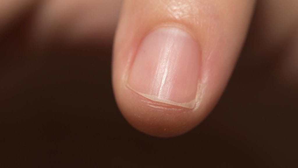 Kynnet kertovat terveydestä.