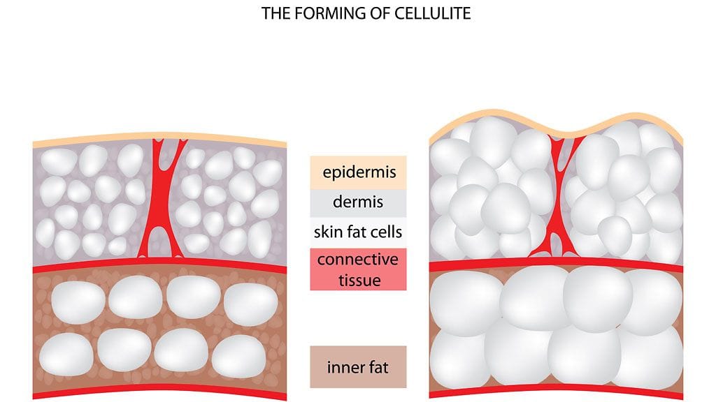 Näin selluliitti syntyy