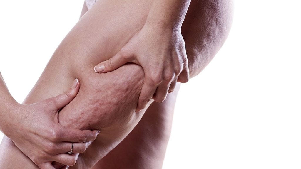 Selluliitille on monenlaisia hoitoja.