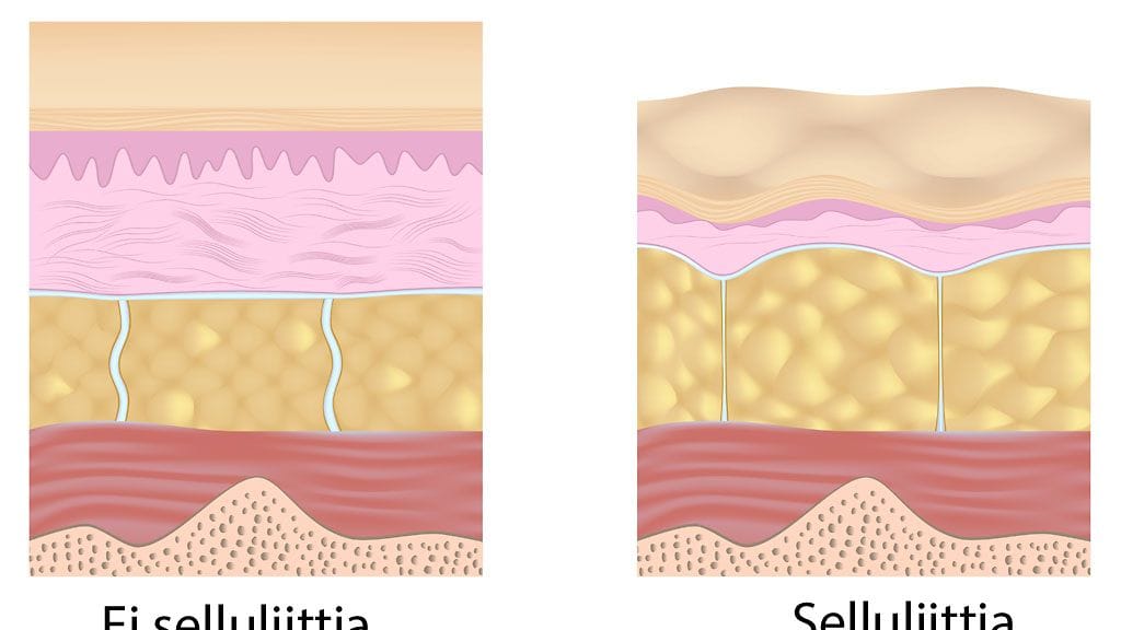 Selluliitin synty