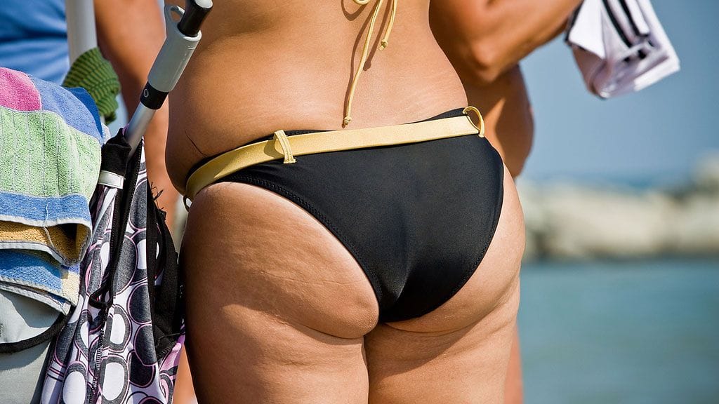 Mitä selluliitti on?