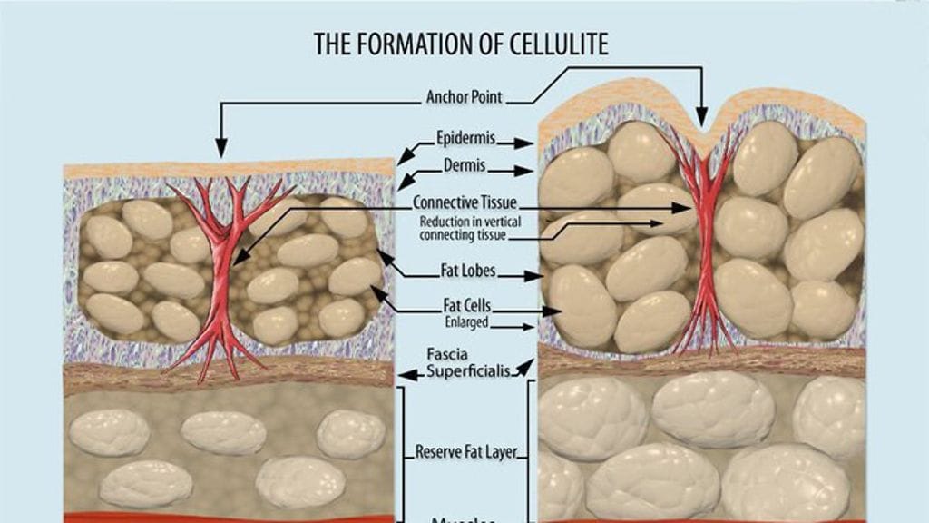 Wikipedian näkemys selluliitin synnystä.