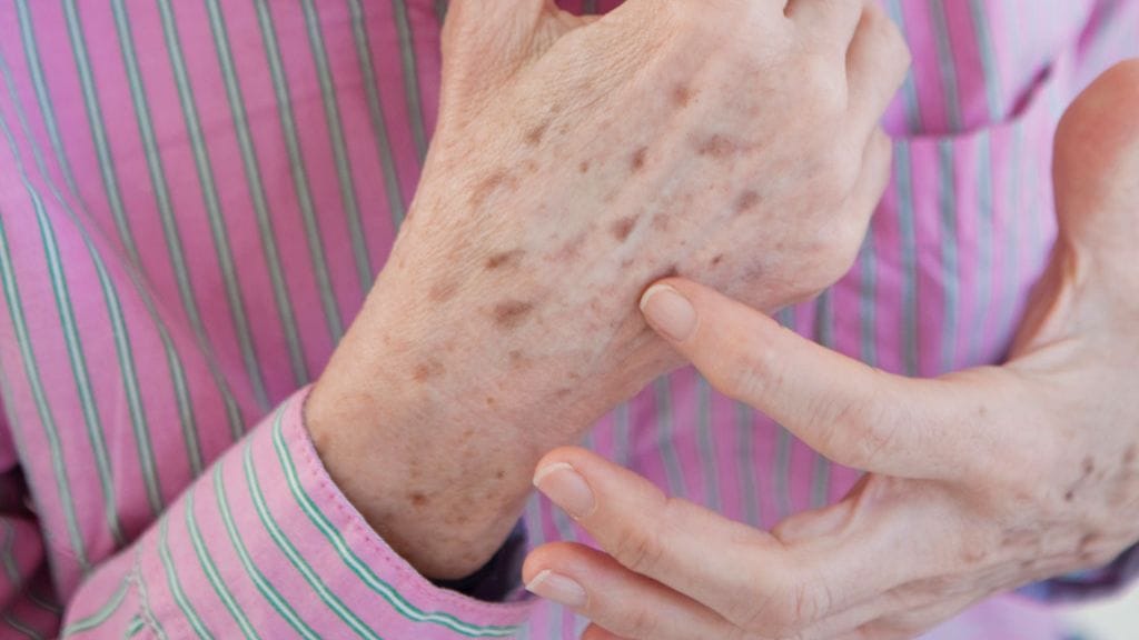 Iäkkään ihmisen "maksaläiskä" on lentigo.