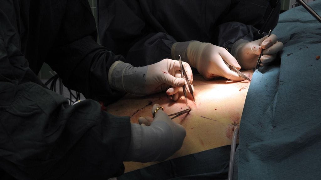 Suomessa tehtiin viime vuonna 888 lihavuusleikkausta.