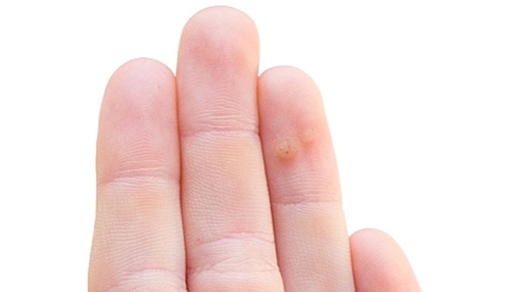 Käsi on yleinen paikka syylille.