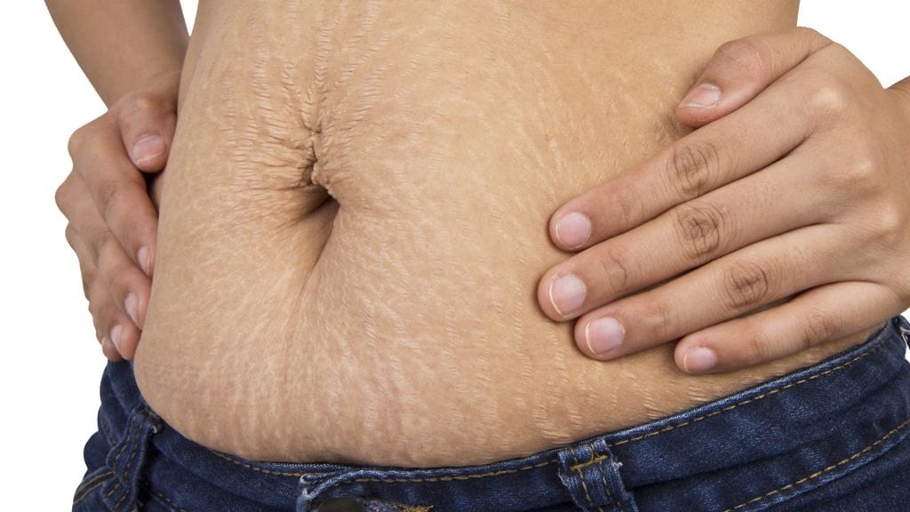 Suurin osa äideistä peittelee raskausarpiaan.