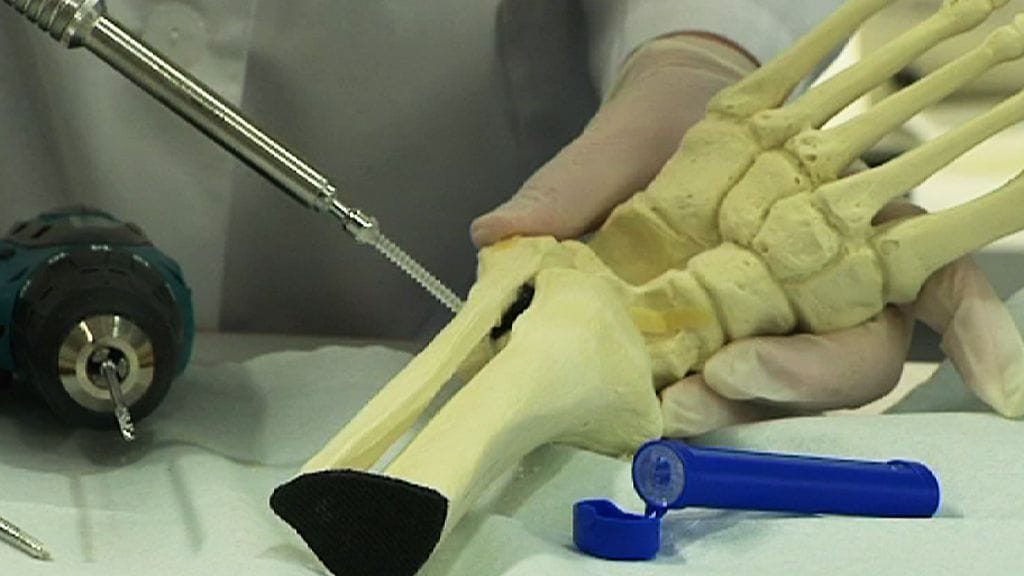 Biohajoavasta luuruuvista vapautuu antibioottia noin kolmen kuukauden ajan.