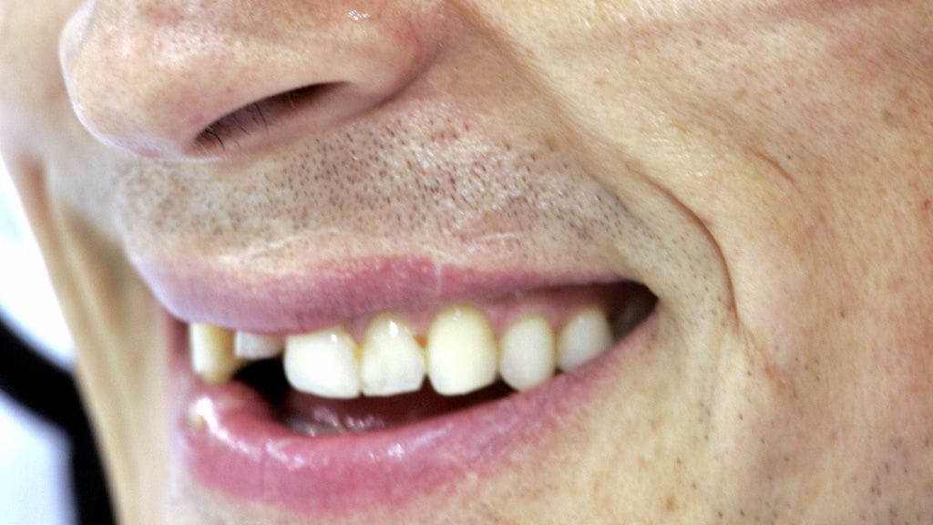 Ihminen pärjää parillakymmenellä hampaalla, kunhan ne ovat suussa symmetrisesti. Kuvituskuva.
