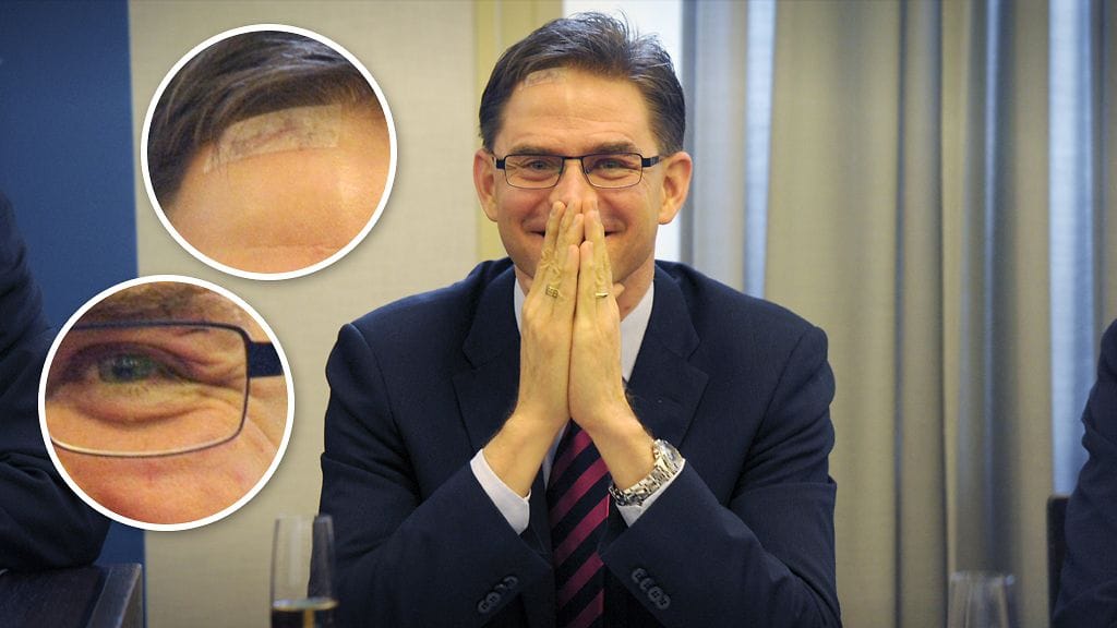 Jyrki Katainen oli yhtä hymyä, vaikka otsassa oli laastari ja 7 tikkiä.