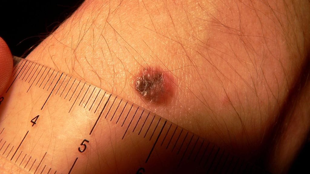 Yleisin melanooman aiheuttaja on auringon ultraviolettisäteily.