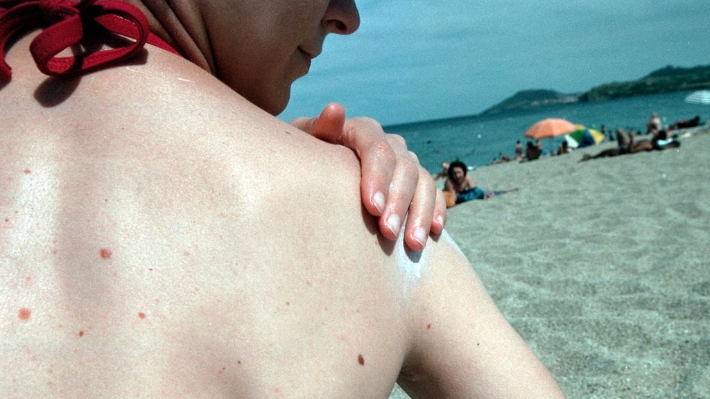 Suomalaisten vaalea iho palaa herkästi. Kuvituskuva.