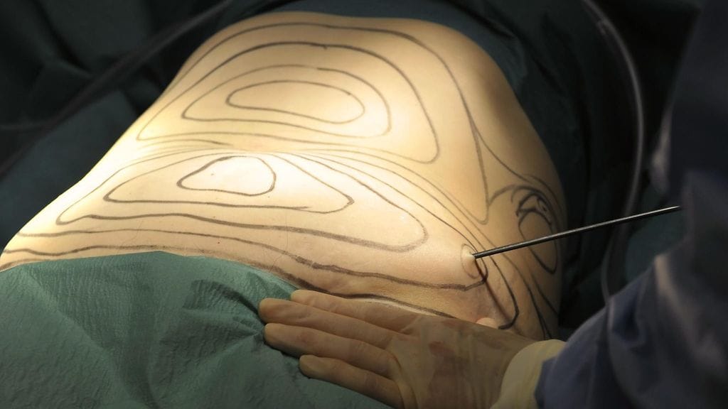 plastiikkakirurgialeikkaus