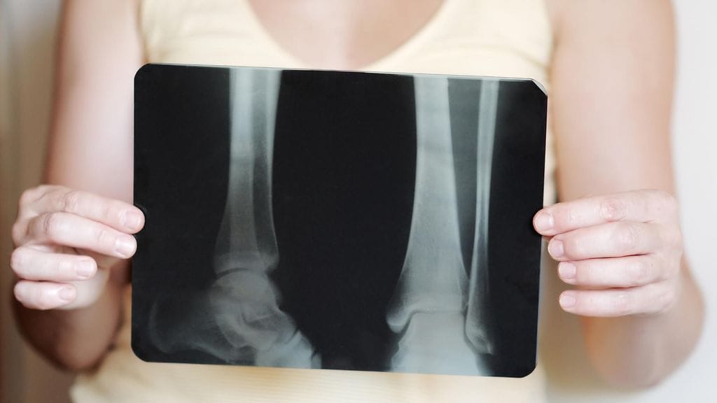 Osteoporoosissa luun lujuus heikkenee. Kuvituskuva.