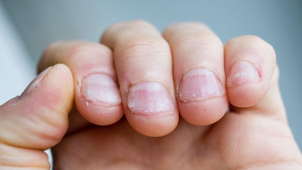 Kun puret kynsiäsi, suuhun pääsee bakteereja, jotka eivät sinne kuulu.