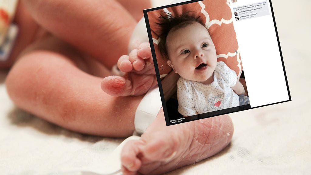 Pieni Abigail-vauva kasvaa normaalin lapsen tavoin sairaudestaan huolimatta.