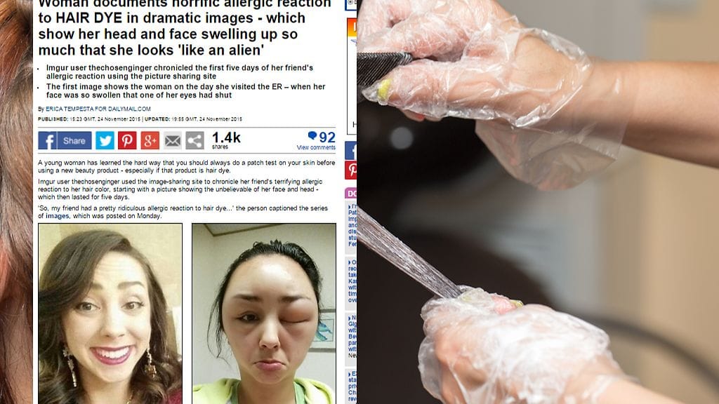 Hiusväriallergia pääsi yllättämään tämän naisen.