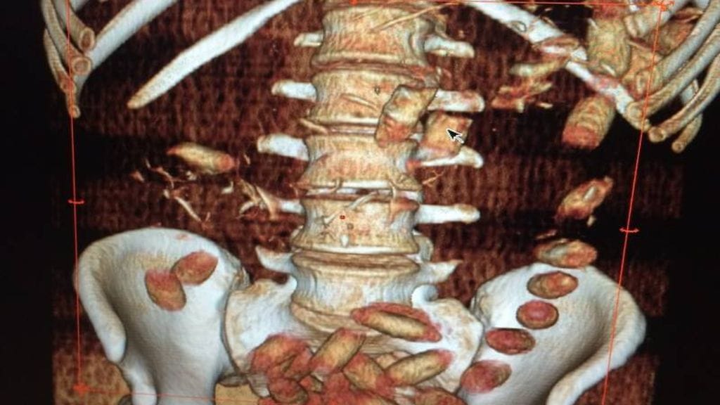 Vaudin kantonin poliisin kuvaa. Kuvassa näkyy vatsalaukussa olevat huumepelletit.