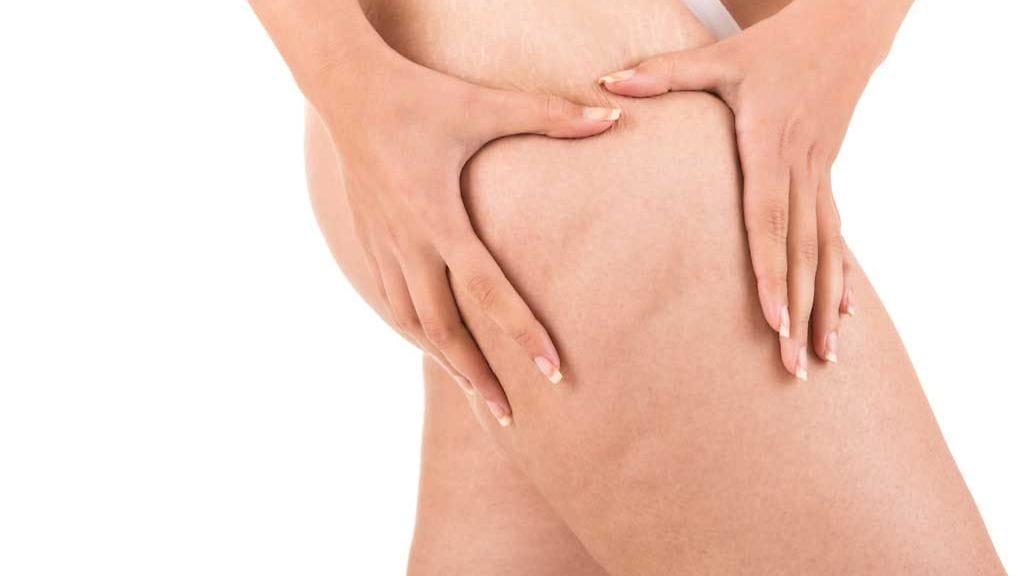 Selluliittiin voivat auttaa terveellinen ruokavalio ja liikunta.