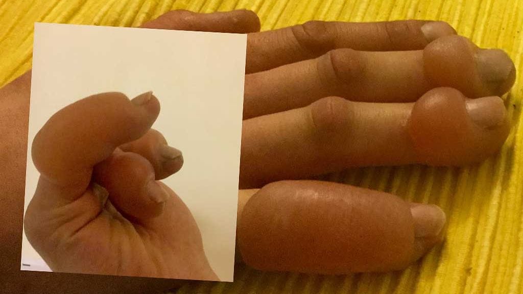 Tapaturmaa seuraavana päivänä sormiin oli noussut suuret rakkulat.