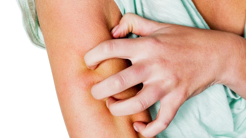 Voiko esimerkiksi maitoallergia laukaista atooppisen ihottuman?