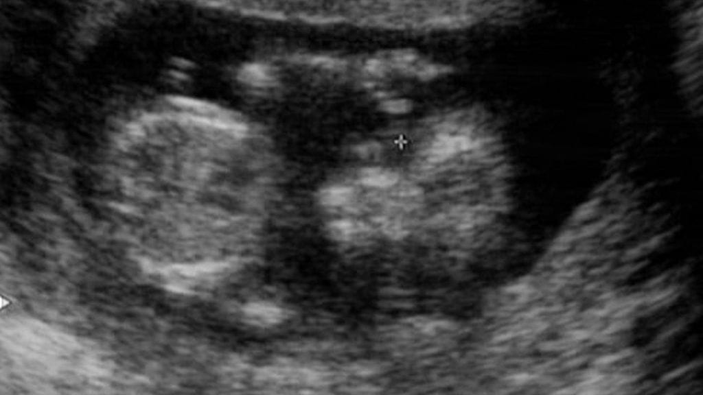 Ensimmäinen ultraääni.