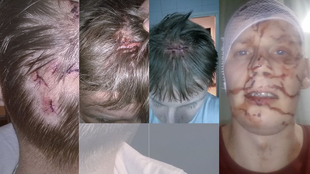 Tältä näyttivät Jori Röntysen haavat heti pahoinpitelyn jälleen.