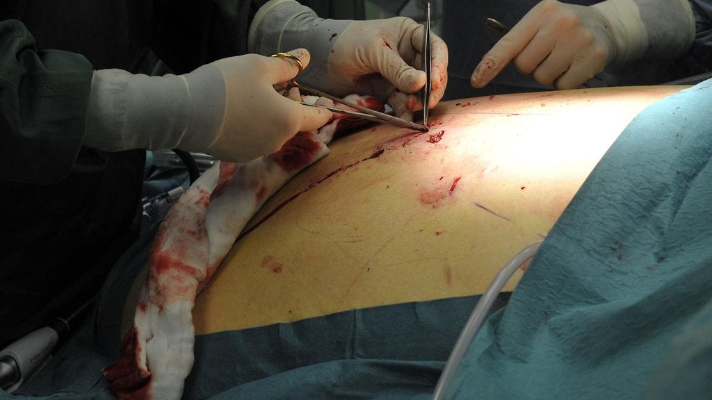 Lihavuusleikkaus HYKS:in Peijas-Rekolan sairaalassa.