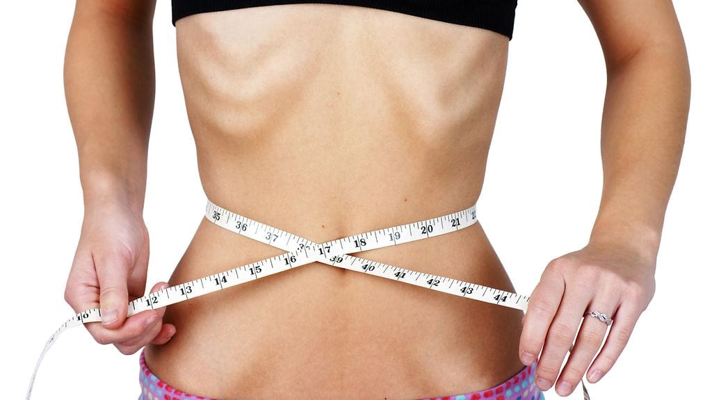 Laihuushäiriö anoreksia kulkee tutkimuksen mukaan suvussa.