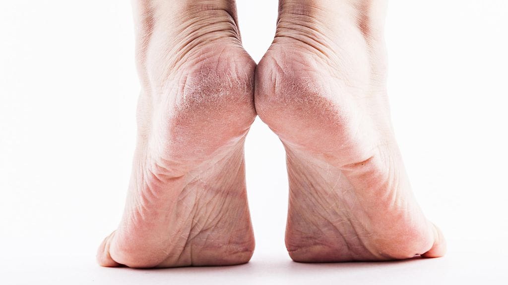 Kantapäiden iho pysyy pehmoisena, kun niitä muistaa rasvata säännöllisesti.