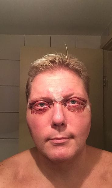 Vesa Keskinen, kauneusleikkaus