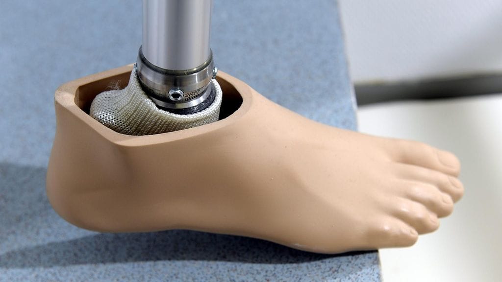 Nuoren naisen molemmat jalat jouduttiin amputoimaan vakavan verenmyrkytyksen seurauksena.