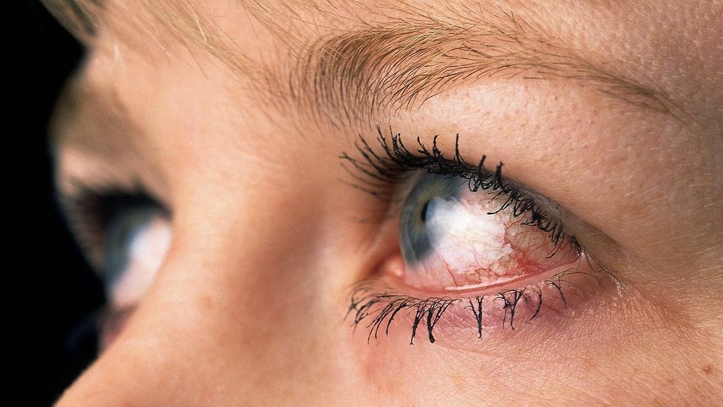 Jopa puolet glaukoomatapauksista jää havaitsematta optikon silmänpainemittauksessa.