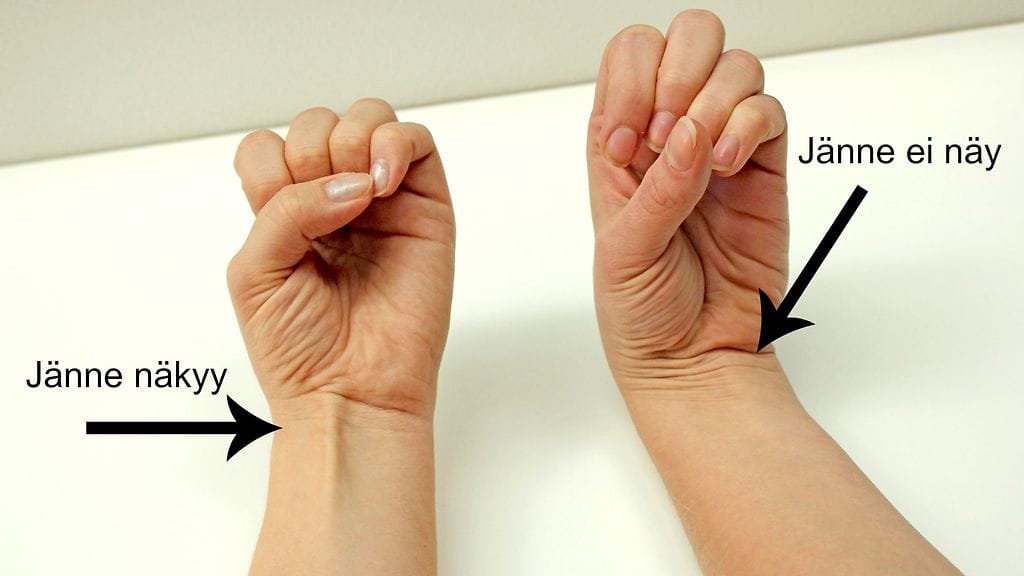 Palmaris longus puuttuu 10–15 prosentilta ihmisiä.